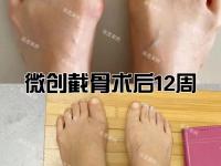 星空体育-JJJ正式接受脚趾手术三个月后重新评估